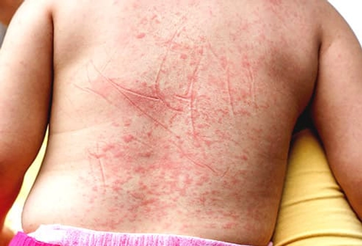 Scarlet Fever Scarlet Fever
