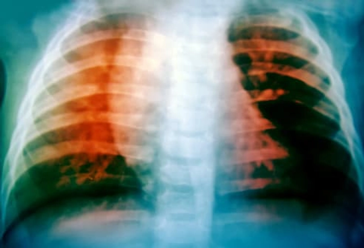 Tuberculosis (TB) Tuberculosis (TB)