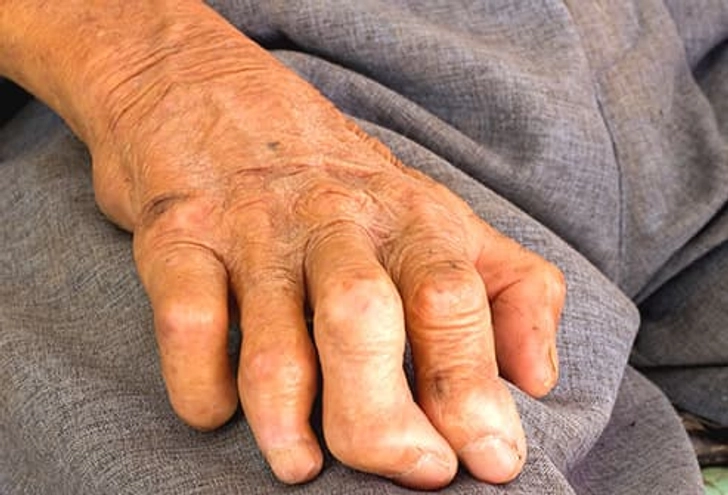Leprosy