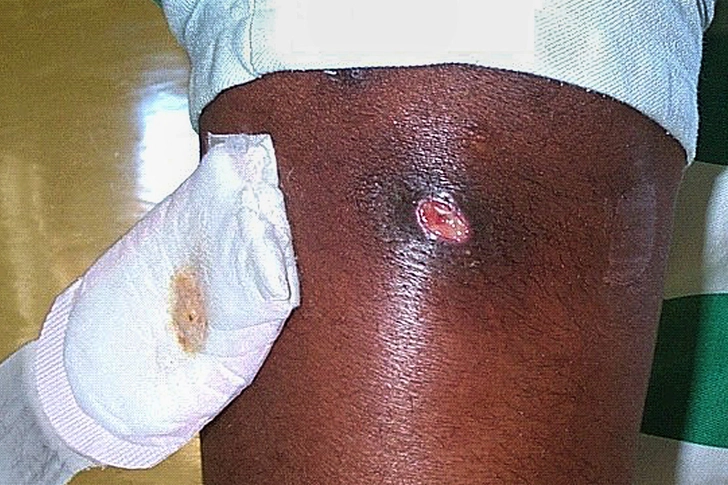 Methicillin-resistant Staphylococcus aureus (MRSA) Methicillin-resistant Staphylococcus aureus (MRSA)