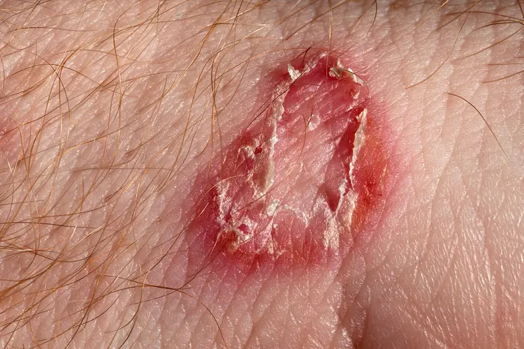 photo of ringworm sore,