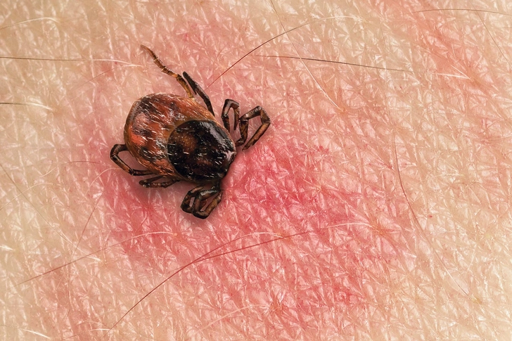 Lyme Disease Lyme Disease