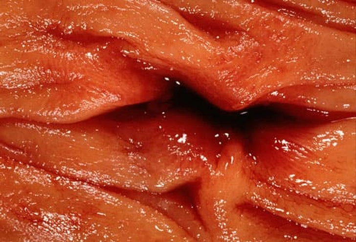 Complications of Diverticulitis