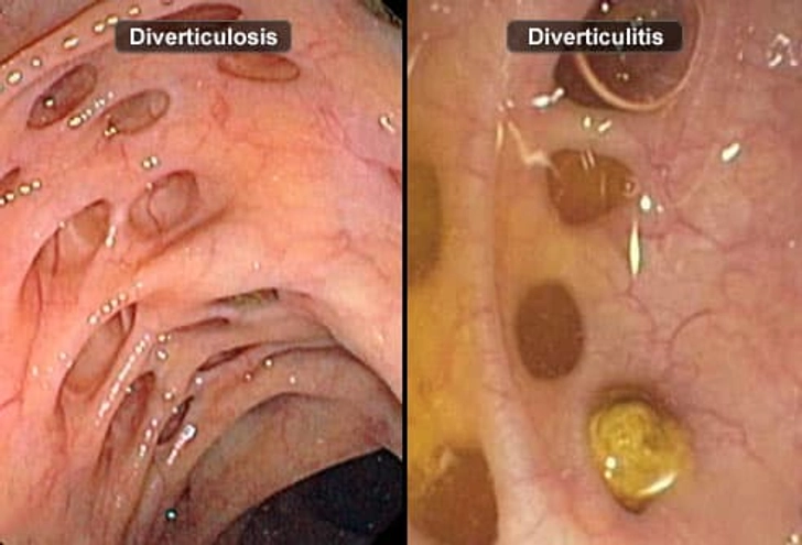 Diverticulosis vs. Diverticulitis