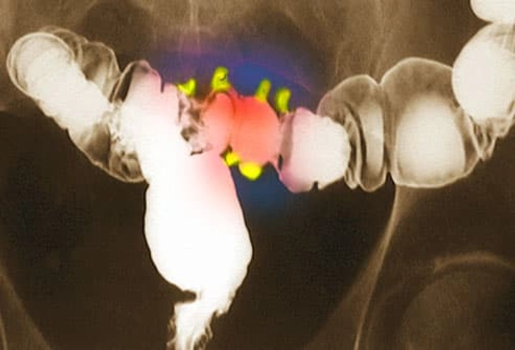 Diagnosing Diverticular Disease