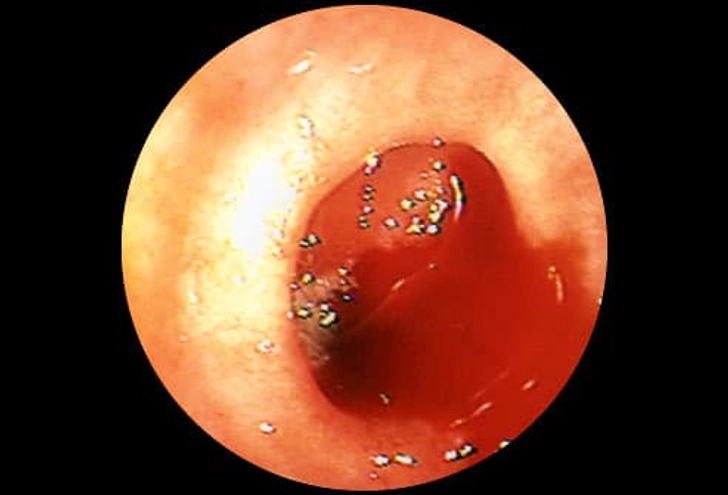 Diverticular Bleeding