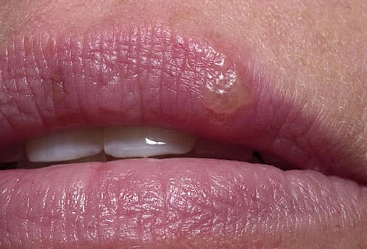 Cold Sore