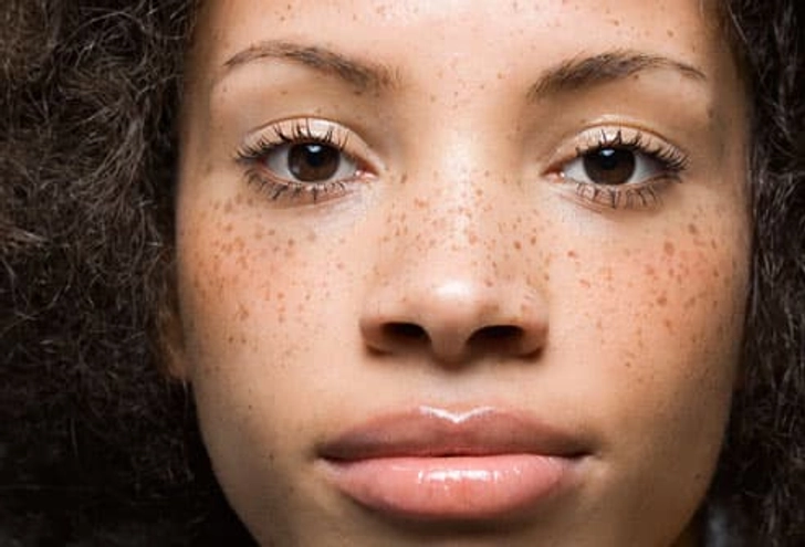 Freckle Face