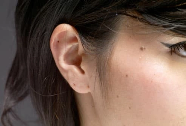 Facial Moles