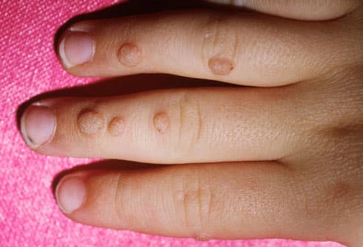 Warts