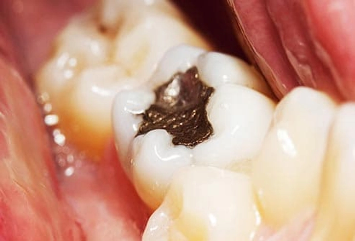 Dental Fillings Dental Fillings