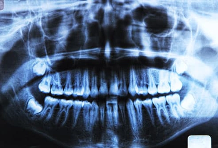 X-rays