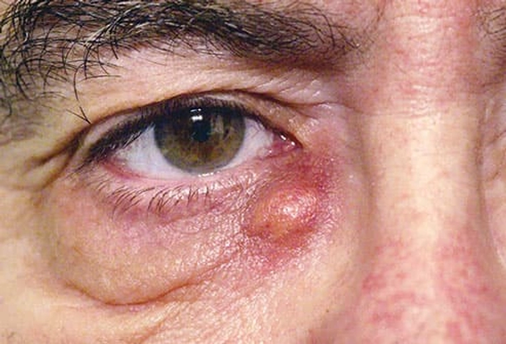 Tear Duct Infection Tear Duct Infection
