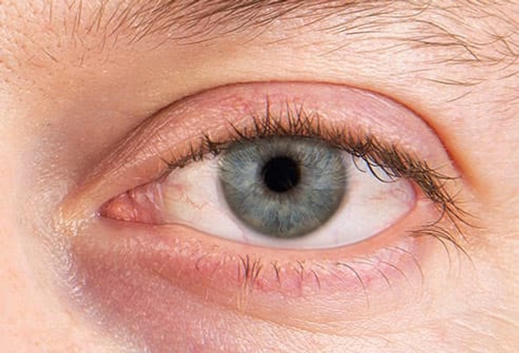 Dry Eye Syndrome Dry Eye Syndrome