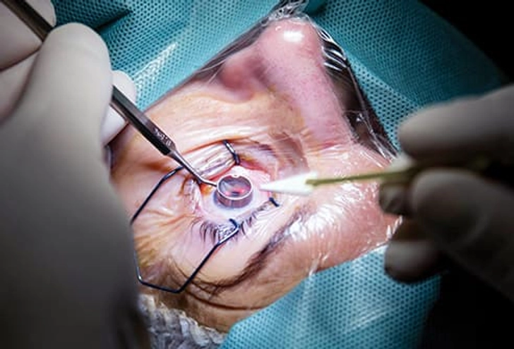 Possible Cause: Eye Surgery Possible Cause: Eye Surgery