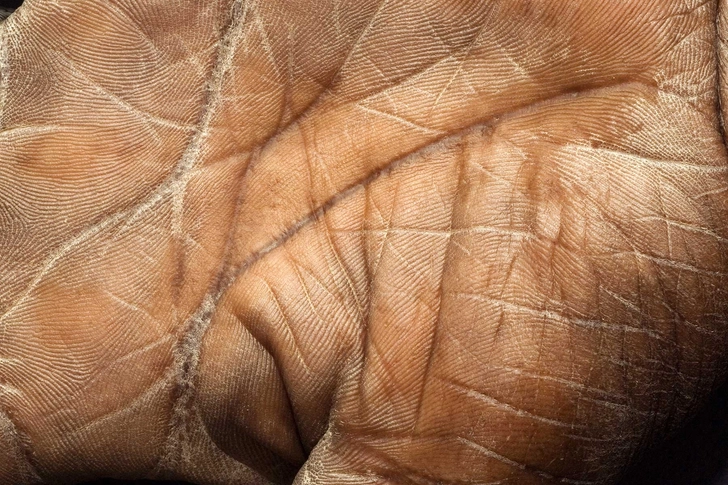 Possible Cause: Fish Scale Disease