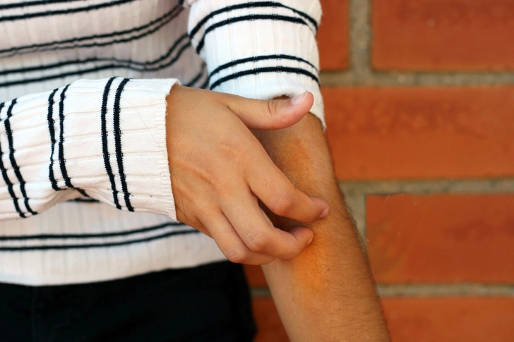 Possible Cause: Atopic Dermatitis