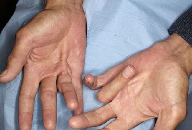Later Symptoms of Dupuytren's Contracture Later Symptoms of Dupuytren's Contracture