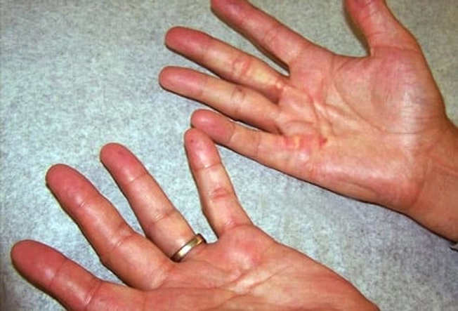 Early Signs of Dupuytren's Contracture Early Signs of Dupuytren's Contracture