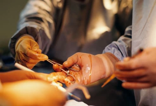 Surgery for Dupuytren's Contracture Surgery for Dupuytren's Contracture