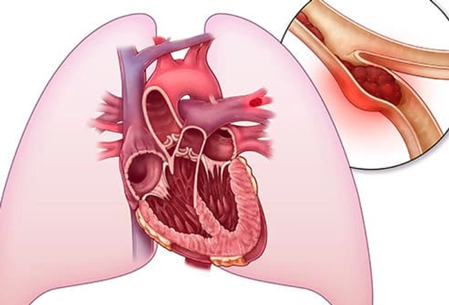 Location: Lung Location: Lung