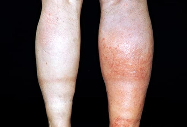 Clue: Swelling Clue: Swelling