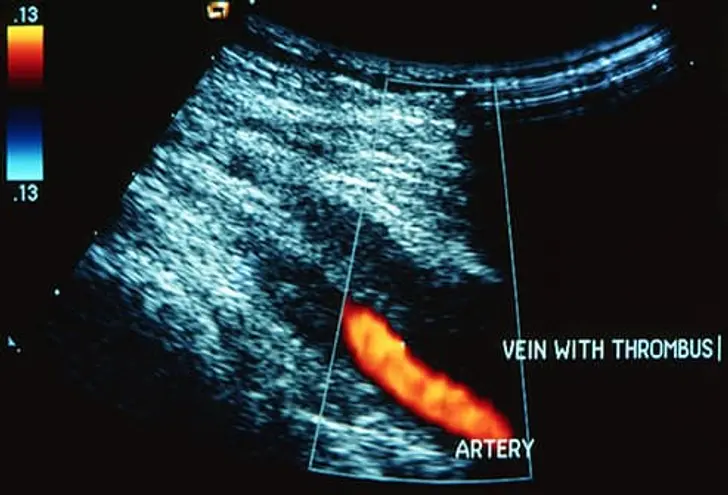 What Is DVT?