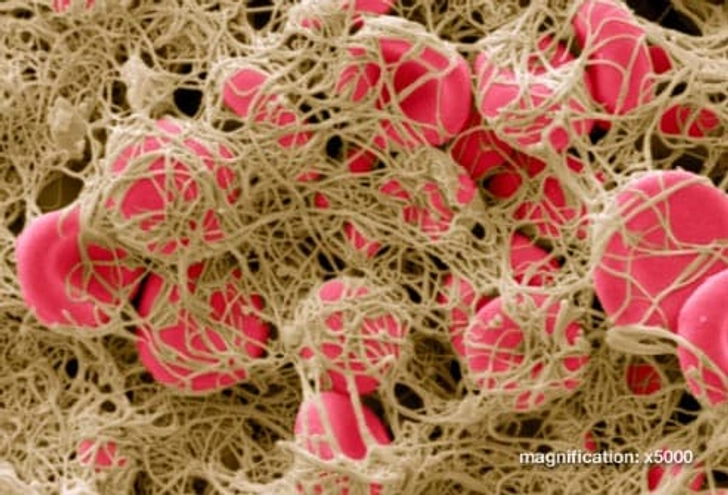What Causes DVT? What Causes DVT?