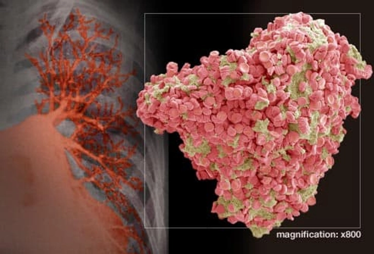 Pulmonary Embolism