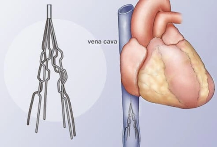 Vena Cava Filter Vena Cava Filter