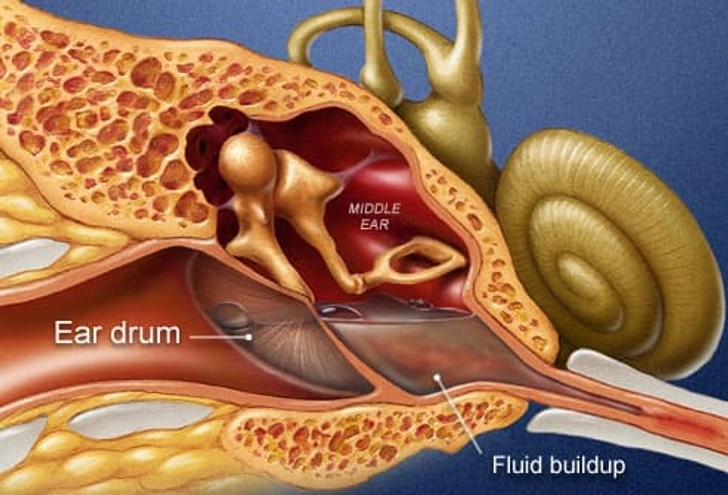 Fluid in the Ear Fluid in the Ear