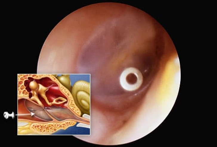 Ear Tubes