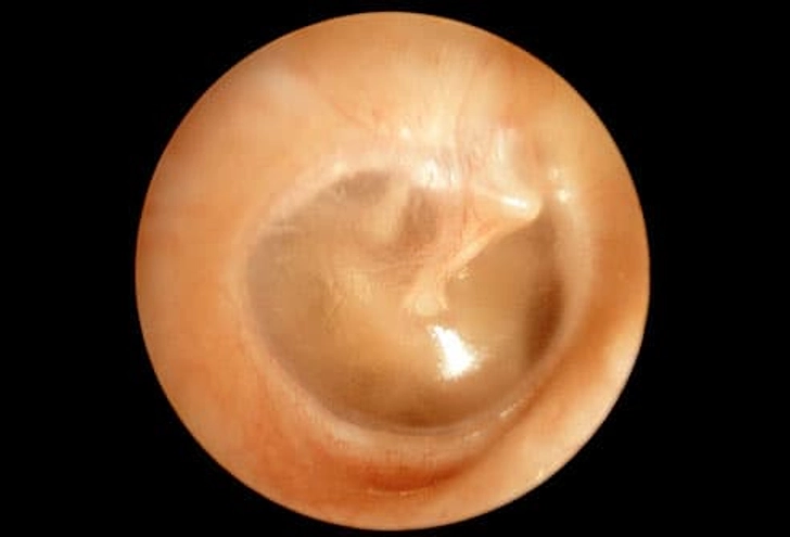 How Doctors Diagnose Ear Infections