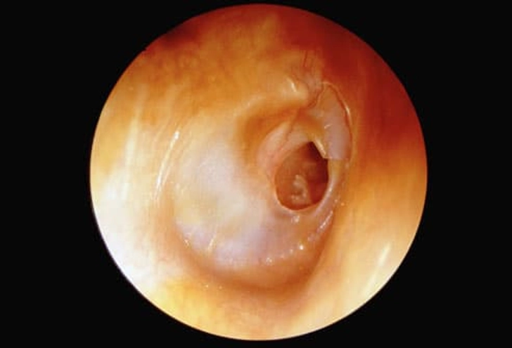 Bursting an Eardrum