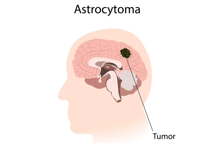 Warning Signs of Astrocytoma Warning Signs of Astrocytoma
