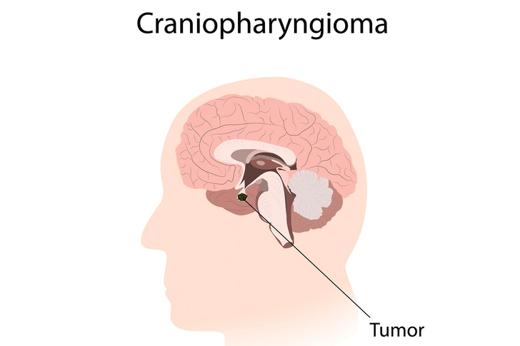 Warning Signs of Craniopharyngioma Warning Signs of Craniopharyngioma
