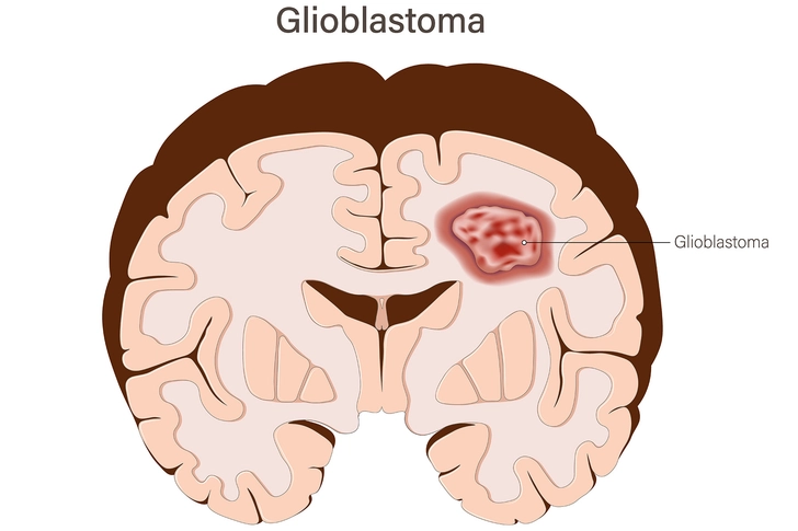 Warning Signs of Glioblastoma Warning Signs of Glioblastoma