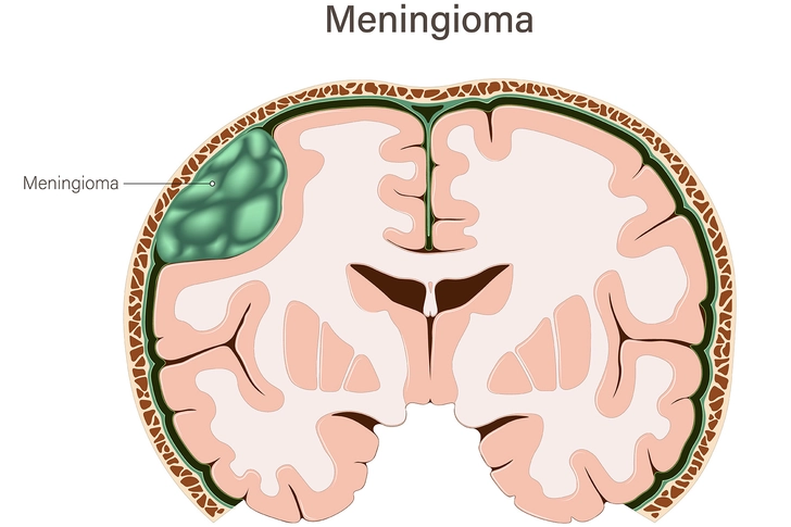 Warning Signs of Meningioma Warning Signs of Meningioma