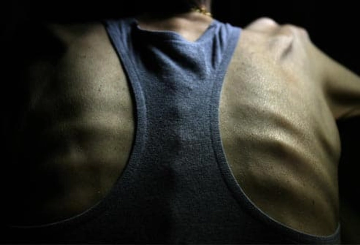 What Is Anorexia?
