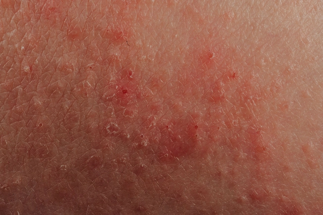 Inflammation and Eczema Symptoms