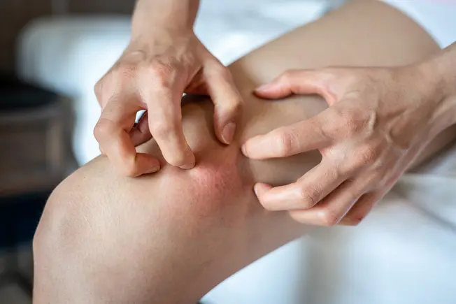 What Is Inflammation? What Is Inflammation?