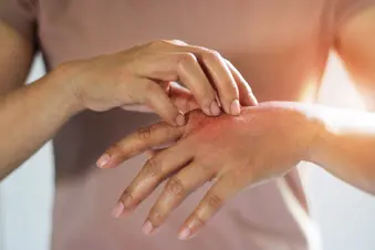 photo of Woman scratching hand