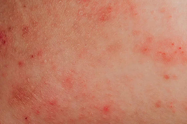 Eczema is a general term that describes several different conditions in which skin is inflamed, red, scaly, and itchy. Atopic dermatitis, which can cause an itchy rash, is one of the most common forms of eczema. (Photo credit: Moment/Getty Images)