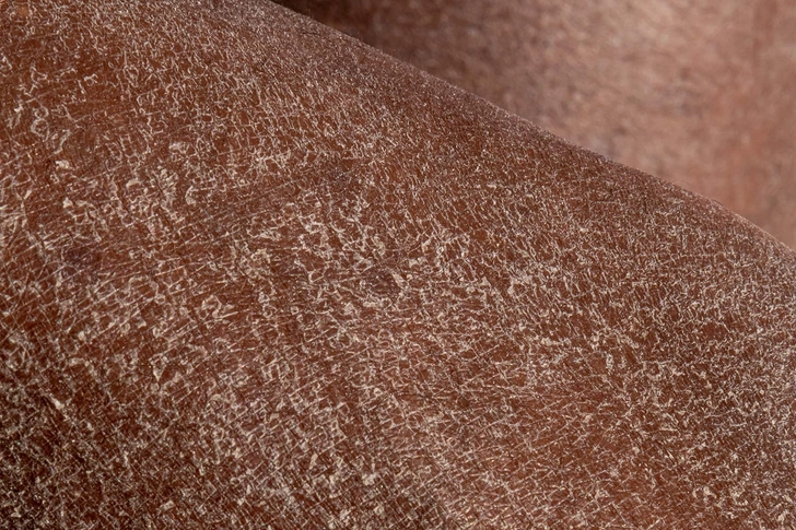 Eczema Symptoms in Older Adults