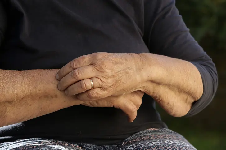 Eczema: Not Just for Kids