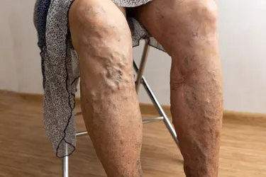 Chronic venous insufficiency can be caused by sitting too much. (Photo Credit: iStock/Getty Images)