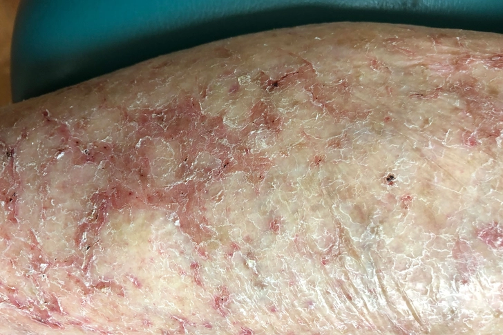 Common Eczemas in Older Adults: Asteatotic Common Eczemas in Older Adults: Asteatotic