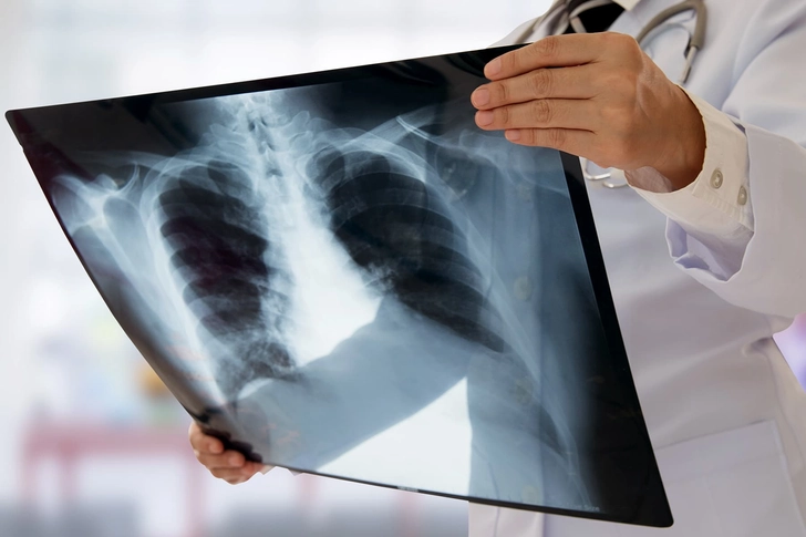 10 Years: Lung Cancer