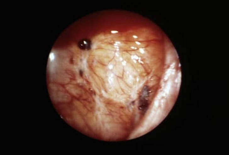 Treatment: Excision