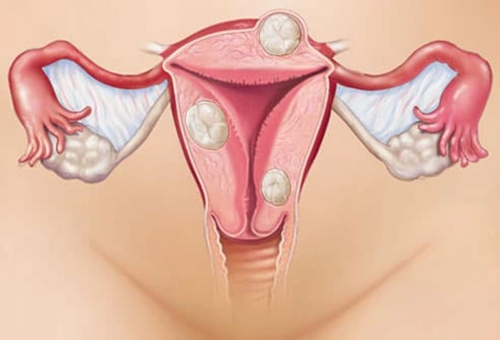 Endometriosis or Fibroids? Endometriosis or Fibroids?